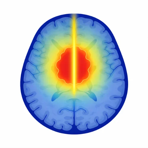 Comparison chart of Gamma Knife vs Zap-X and CyberKnife for brain tumor precision